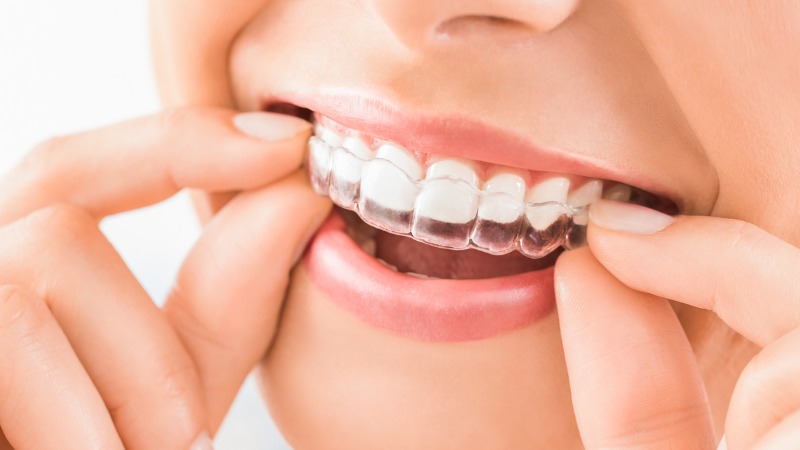 les aligneurs orthodontiques